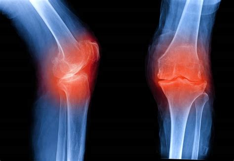 Etapele osteoartritei genunchiului